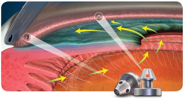 緑内障手術のイメージイラスト